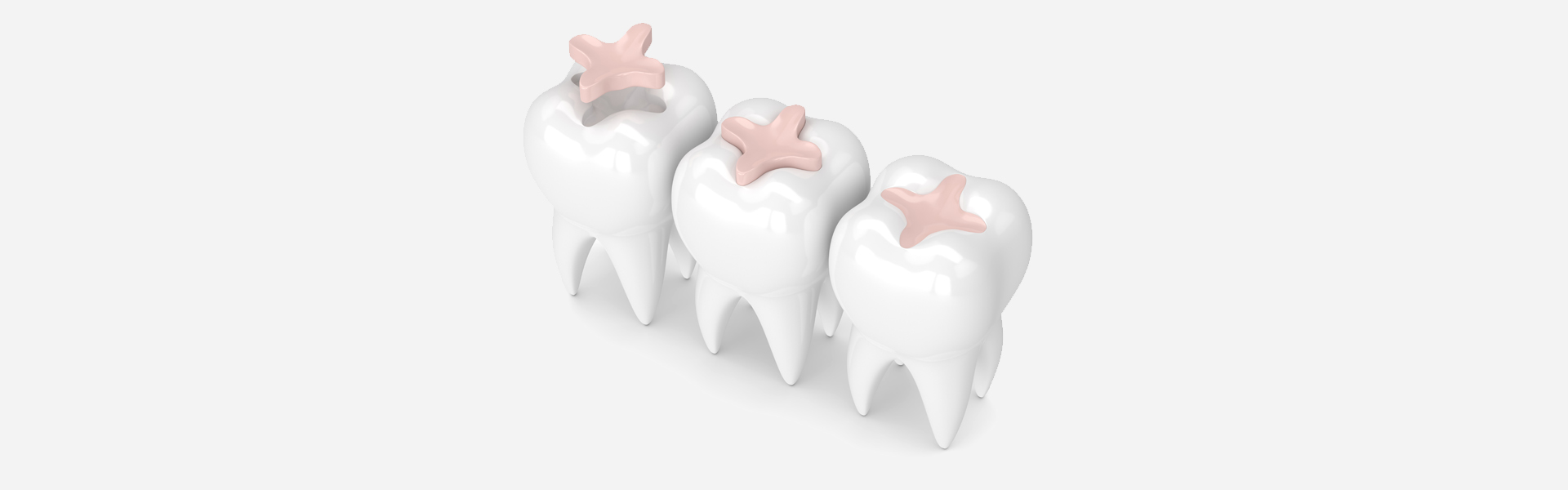 Temporary Filling After Root Canal: What Comes Next