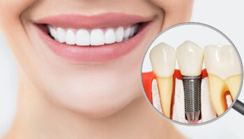 Dental Implants for Missing Front Teeth: Restoring Your Smile