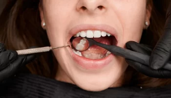 Can Wisdom Teeth Cause Crowding or Shift Other Teeth? What Patients Should Know