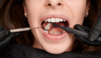 Can Wisdom Teeth Cause Crowding or Shift Other Teeth? What Patients Should Know